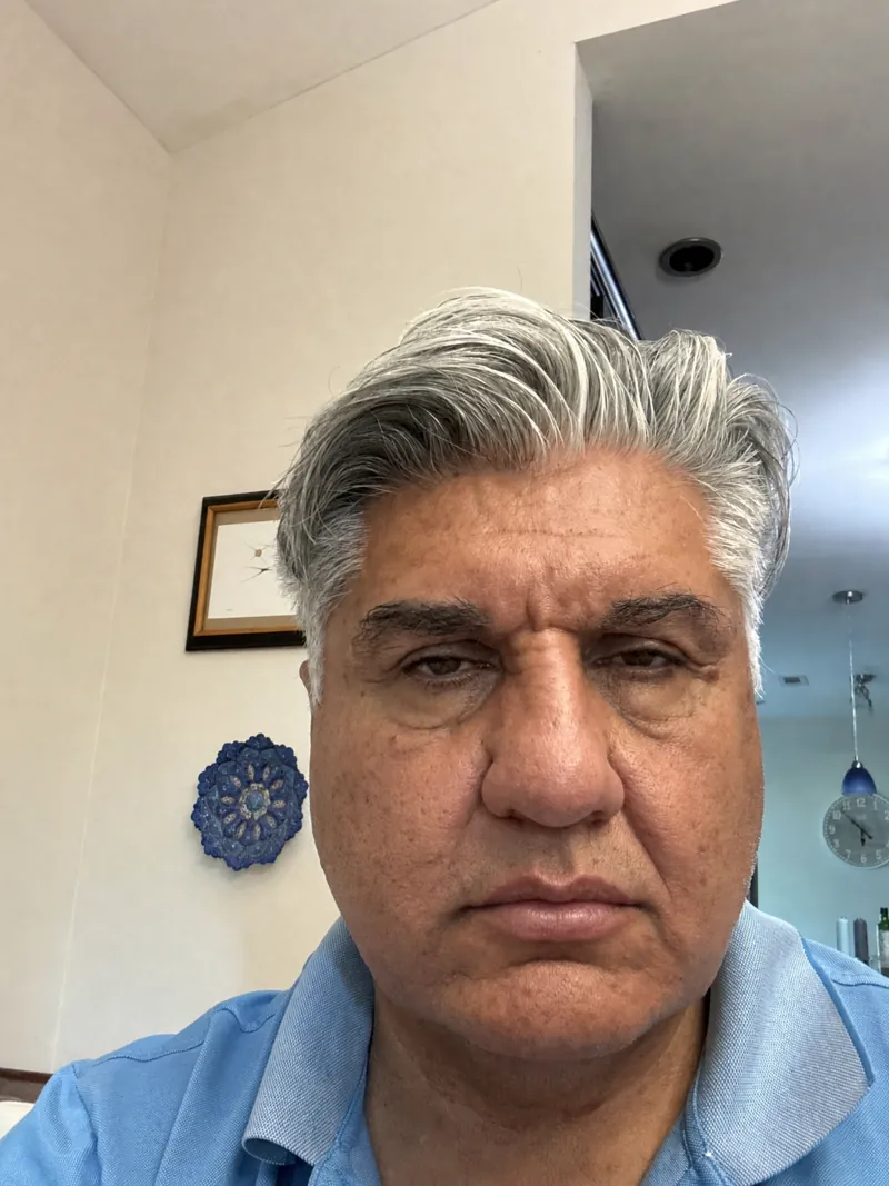 AI simulation of Lip Filler