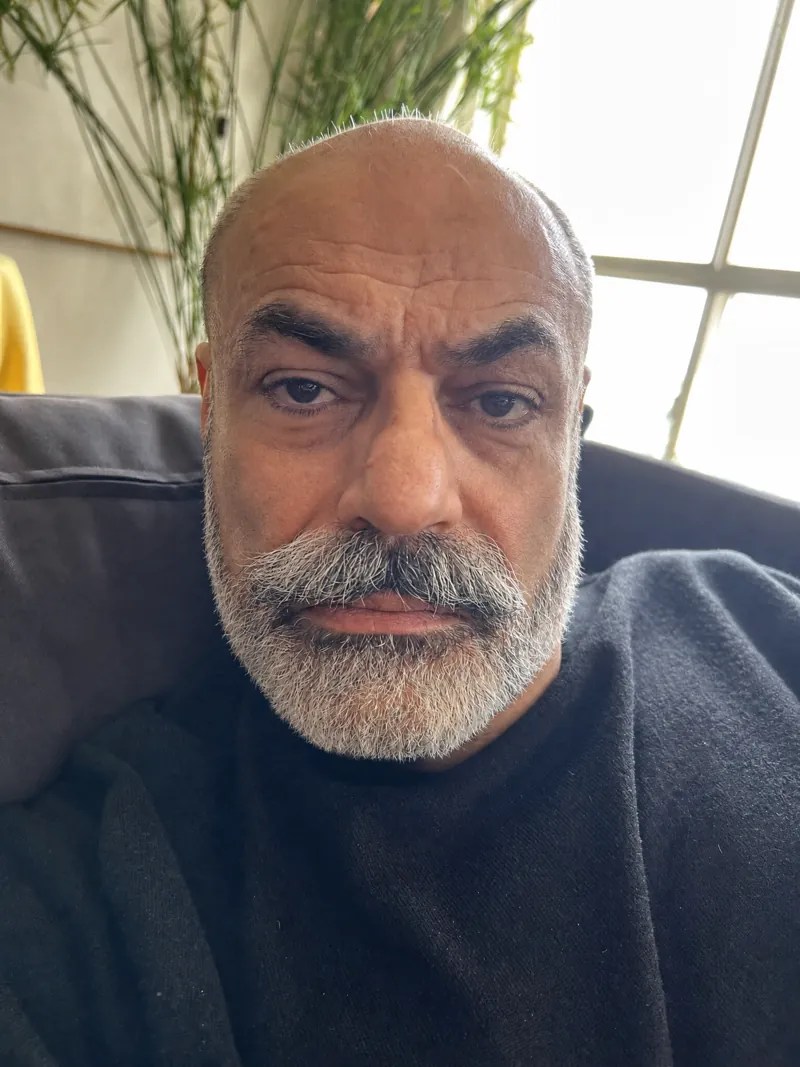 AI simulation of Jawline Filler