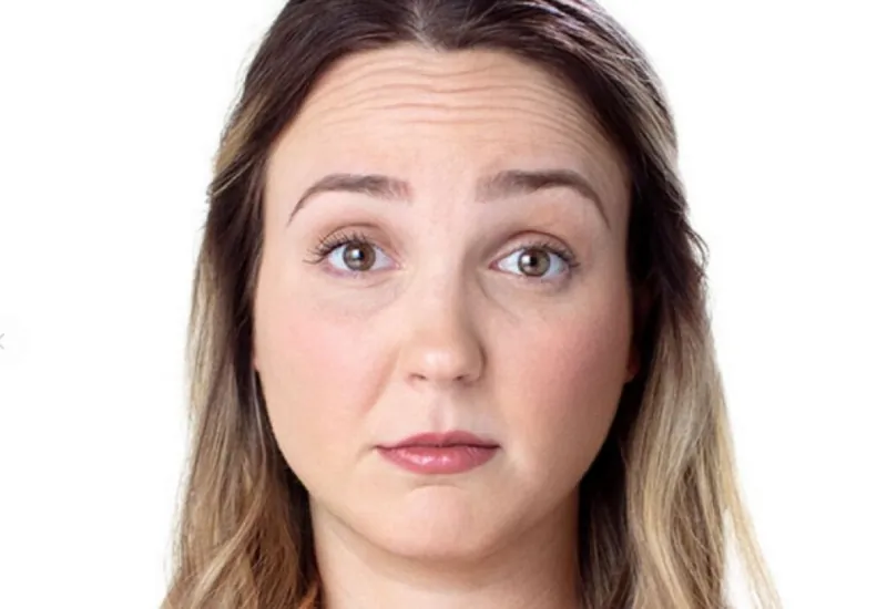 Original photo before Botox (Crow's Feet)