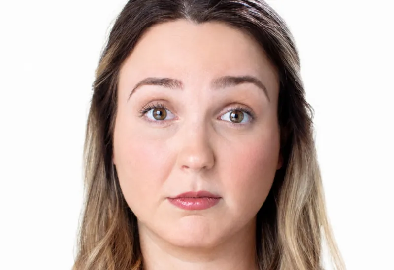 AI simulation of Botox (Crow's Feet)