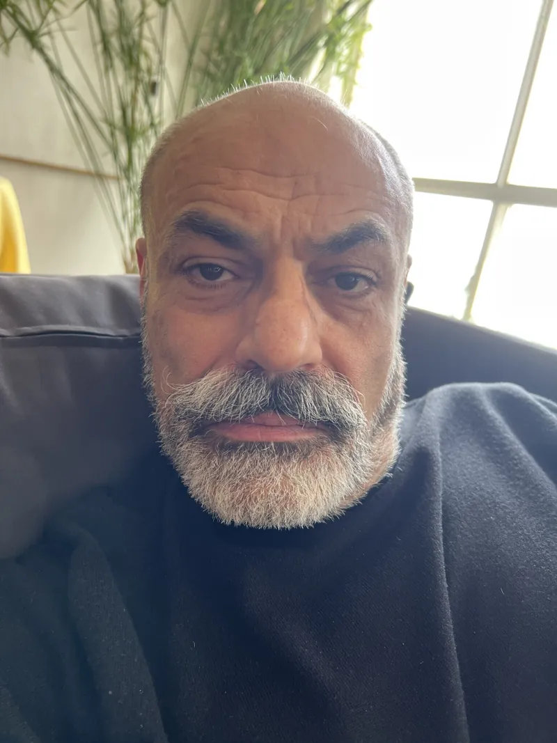 Original photo before Botox (Glabella)